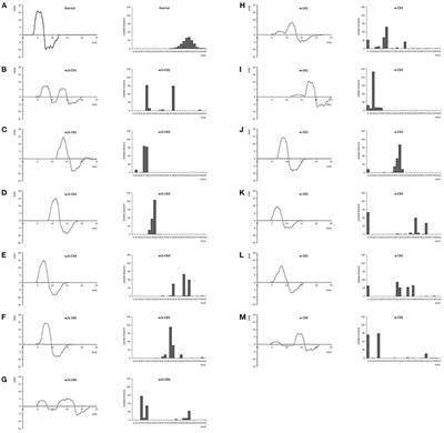 LSTM Neural Network for Inferring Conduction Velocity Distribution in Demyelinating Neuropathies